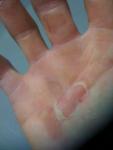 Small blisters after the Sark to Jersey race 
